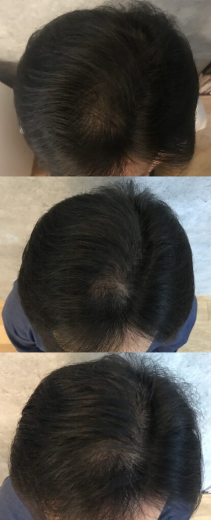 20210827_約4週間後の頭髪状態_初期と比較