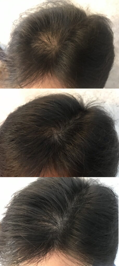 20211030_初期の頭髪状態_2ヶ月後_3ヶ月後を比較